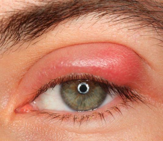 Лечение внутреннего ячменя на нижнем веке внутри глаза Ячмень может быть на верхнем веке