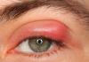 Liječenje unutarnjeg očnog kapka na donjem kapku unutar oka Čvičnjak može biti na gornjem kapku
