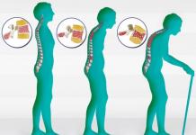 Osteoporozun nedenleri, belirtileri ve tedavisi, korunma