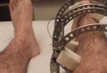 Aparato de Ilizarov en la pierna tiempo de tratamiento del problema Se instaló el aparato de Ilizarov Complicaciones