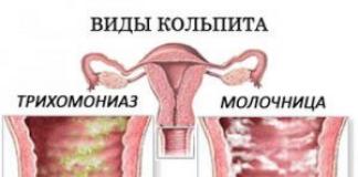 Признаки трихомонадного кольпита у женщин и его лечение