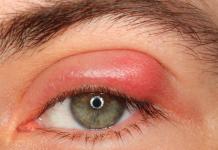 Tratamiento del orzuelo interno en el párpado inferior dentro del ojo. El orzuelo puede estar en el párpado superior.