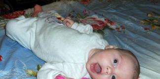 Тортиколис при новородени: лечение, признаци, причини, последствия
