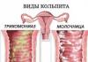 Signos de colitis por tricomonas en mujeres y su tratamiento.