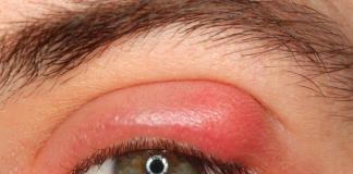 Tratamiento del orzuelo interno en el párpado inferior dentro del ojo. El orzuelo puede estar en el párpado superior.